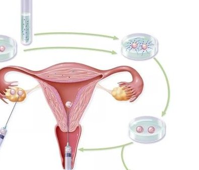 精子畸形是男性不孕的关键，精子畸形通常是这些原因导致的