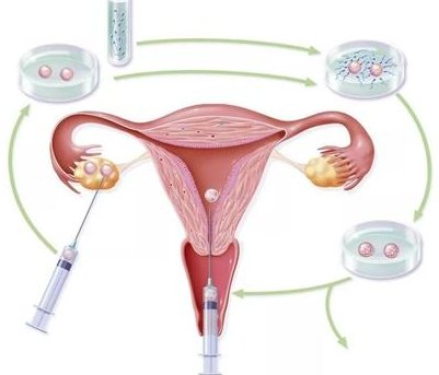 试管婴儿方式不同费用不同，附降低试管婴儿费用的方式！